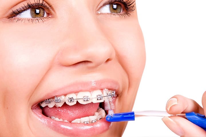 Trucos para limpiar tu ortodoncia - Dental Tutor