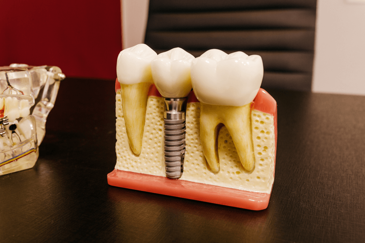 tipos de implantes dentales en calahorra