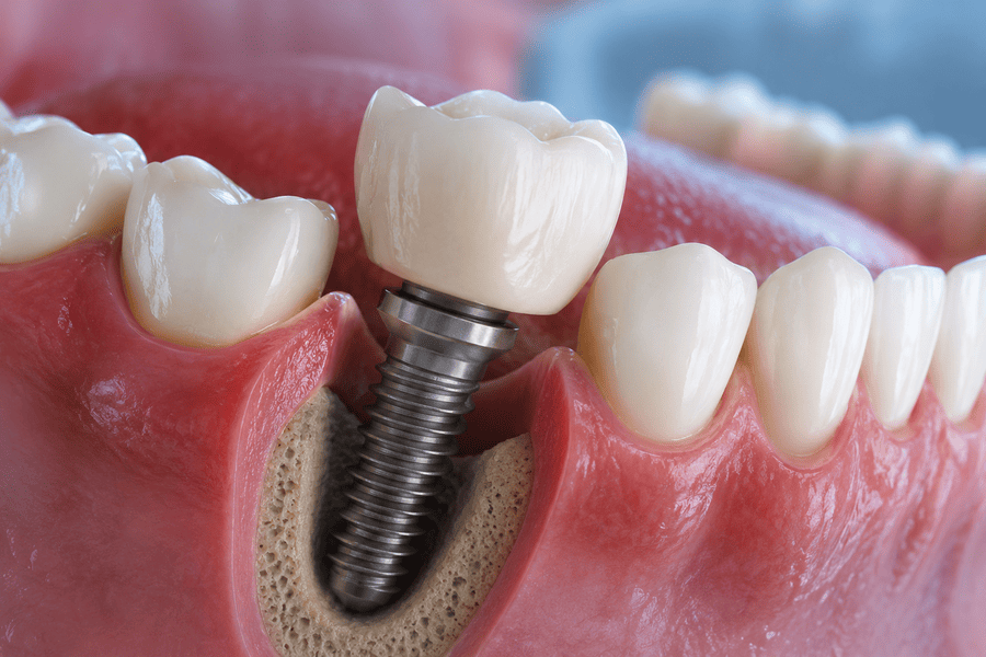 ¿Es normal que un implante dental se mueva?